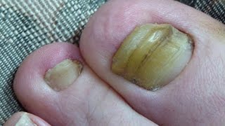 Toenail Fungus Cured 2 Years Progress [upl. by Delaney381]