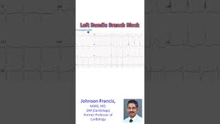 Left Bundle Branch Block [upl. by Greenwald]