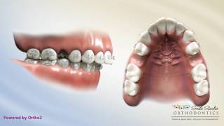 Upper 2nd Bicuspid Extraction  Overjet  Orthodontic Treatment [upl. by Siderf]