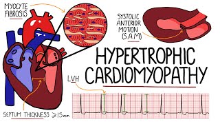 Hypertrophic Cardiomyopathy Made Easy  Includes Hypertrophic Obstructive Cardiomyopathy amp SAM [upl. by Emmett]