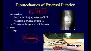 Orthopaedic Implants 2  External Fixation [upl. by Wales]