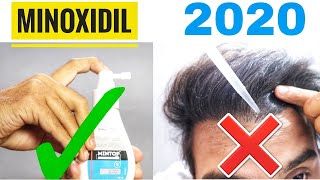 How to use Minoxidil properly  Use this way to get best Minoxidil Results [upl. by Nuawtna]