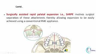 Arch expansion in orthodontics part 2 made easy  Orthodontics  Dentophile [upl. by Glorianna]