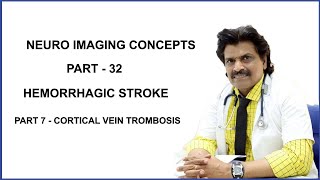 NEUROIMAGING PART32HEMORRHAGIC STROKEPART 7  CORTICAL VEIN TROMBOSIS [upl. by Castera]