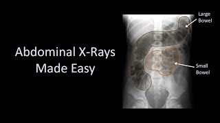 Abdominal XRays Made Easy [upl. by Hassett]