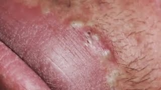 Blackheads amp Whiteheads Satisfying Removal 0137 [upl. by Thadeus]