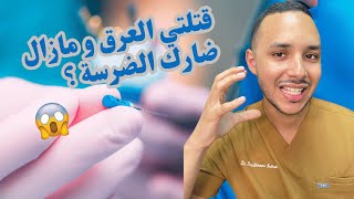 قتلتي العرق و مازال ضارك الضرسة ؟واش عادي أو لا؟ [upl. by Hamon307]