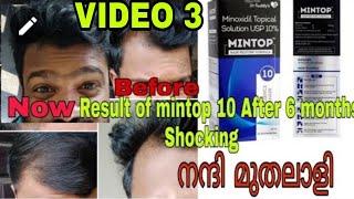 Minoxidil mintop 10 faster hair regrow solution result after 6 months part 3 [upl. by Vladimar]