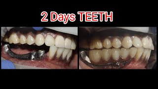 HOW TO MAKE BREDENT GUM COLOR FOR PMMA PROSTHESIS MOLOR BRIDGE [upl. by Garris161]