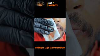 vitiligo lips vitiligo on lips causes treatments and useful tips white patches on lips [upl. by Saqaw]