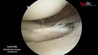 Watch a Knee Surgeon Treat a Meniscal Tear [upl. by Areis]