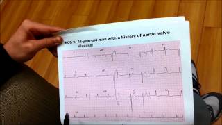 EKG 2 48YearOld Male With a History of AORTIC VALVE DISEASE [upl. by Ayotal]