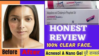 Acnesol A Nano Gel Honest Review Adapalene and Clindamycin Phosphate Gel 7 दिन में पिंपल्स गायब [upl. by Mcquade]