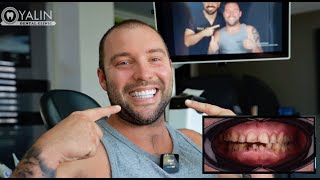 Full Mouth Zirconium Crowns Cost in Turkey Antalya  YALIN Dental Clinic Turkey  Testimonials [upl. by Dahaf]