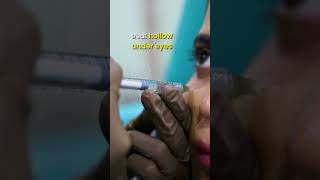 Dermal Fillers 💉🧏‍♀️ for Face lift Eyebrows and Scars  Dr Priyanka Reddy  DNA Skin Clinic [upl. by Kathryne915]