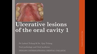 Ulcerative lesions of the oral cavity 1 [upl. by Abbe]