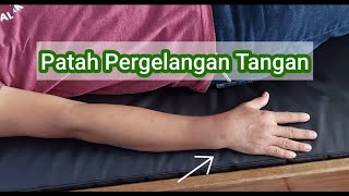 Latihan patah pergelangan tangan colles fracture pergelangan tangan bengkok [upl. by Kaczer]