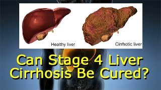 Can Stage 4 Liver Cirrhosis Be Cured [upl. by Porcia]