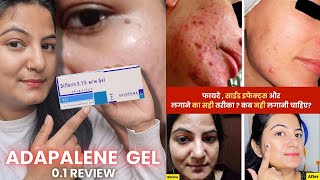 How to Use Adapalene Gel 01  Full Detail Video  Best Gel For Removing Blackheads and Pimples [upl. by Aysa]