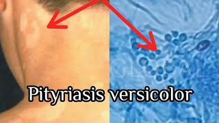 Pityriasis Versicolor under the microscope [upl. by Arathorn66]