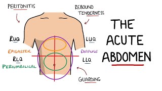 Acute Abdomen  A Guide to Acute Abdominal Pain [upl. by Manton200]