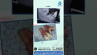 Say Goodbye to Dental Pain with Safe Tooth Extraction at Pragya Dental Clinic [upl. by Einnahpets]