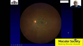 Diabetic Macular Oedema [upl. by Hilar367]