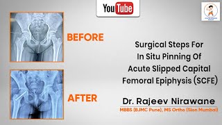 Watch the Procedure for In Situ Fixation in SCFE Treatment by Dr Rajeev Nirawane [upl. by Southworth]