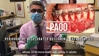 Adult Orthodontics PAOO [upl. by Gurias]