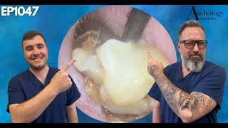 WET MASTOIDECTOMY EAR WAX REMOVAL  EP1047 [upl. by Adaliah]