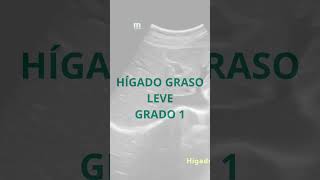 HÍGADO GRASO LEVE O GRADO 1 POR ECOGRAFIA higadograso fattyliver ecografia [upl. by Witte]