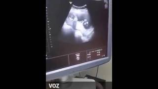 Primer embarazo gemelar mediante FIV  Gestar In Vitro Chiclayo [upl. by Moht]