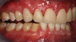 Smile Makeover Worn Dentition  Tooth Wear Case Study with Dr Dennis Hartlieb [upl. by Iago307]