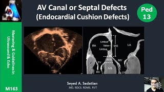 AV Canal or Septal Defects Endocardial Cushion Defects [upl. by Napoleon]