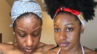 HOW TO CLEAR ACNE IN LESS THAN A MONTH [upl. by Goat552]