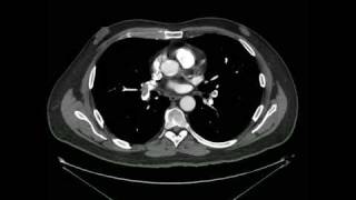 Tromboembolismo Pulmonar Angio tomografia [upl. by Mercy]