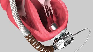 Medical Device Animation Heartware System LVAD Pump [upl. by Denby]