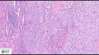 Lung squamous cell carcinoma Microscopy  Talking slide [upl. by Assej129]