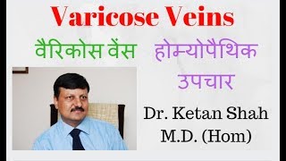 Varicose Veins Treatment in Hindi  वैरिकोज वेन्स  Homeopathy  Dr Ketan Shah [upl. by Brunhild]