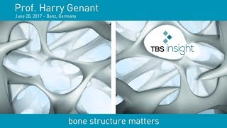 Prof Dr Harry Genant about TBS [upl. by Nasia]