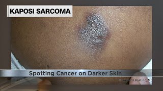 How to spot melanoma and other cancers on darker skin [upl. by Rehpotsirhcnhoj288]