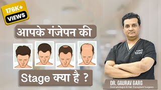 How to Recognize Your Grade of Baldness  How many Grafts do I Need for Hair Transplant [upl. by Dressler852]