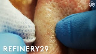 Why Extractions Are Satisfying To Watch But Dangerous  Macro Beauty  Refinery29 [upl. by Ahtenak]