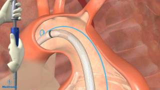 Thoracic Endovascular Aortic Aneurysm Repair in Dallas [upl. by Zedekiah]