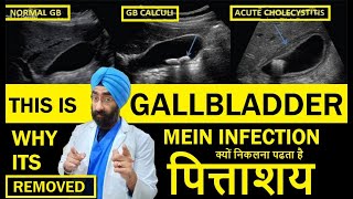 Understand Cholecystitis  Gall Bladder Swelling Sludge amp Infection  DrEducation Hindi Eng [upl. by Derte600]