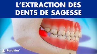 Extraction de dent de sagesse et péricoronarite © [upl. by Adnov]