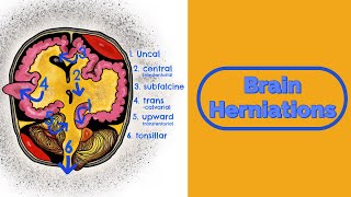 Brain Herniations and Raised ICP [upl. by Roldan888]