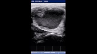 THYROID CYST ultrasound hormones thyroid [upl. by Henriha139]