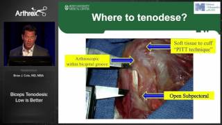 Biceps Tenodesis Low is Better [upl. by Ahsenhoj]