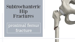 Subtrochanteric hip fractures  proximal femur fractures [upl. by Balcke]